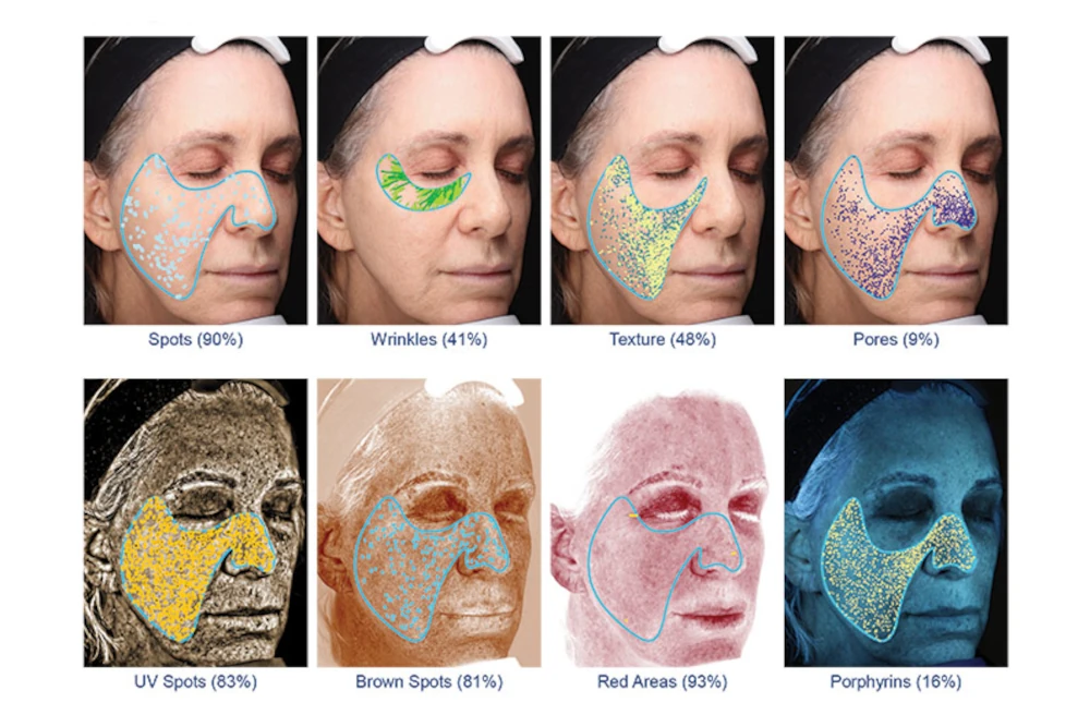 Visual Skin Depth Inches Visia Skin Analysis - Ideal Mind & Body Wellness Center
